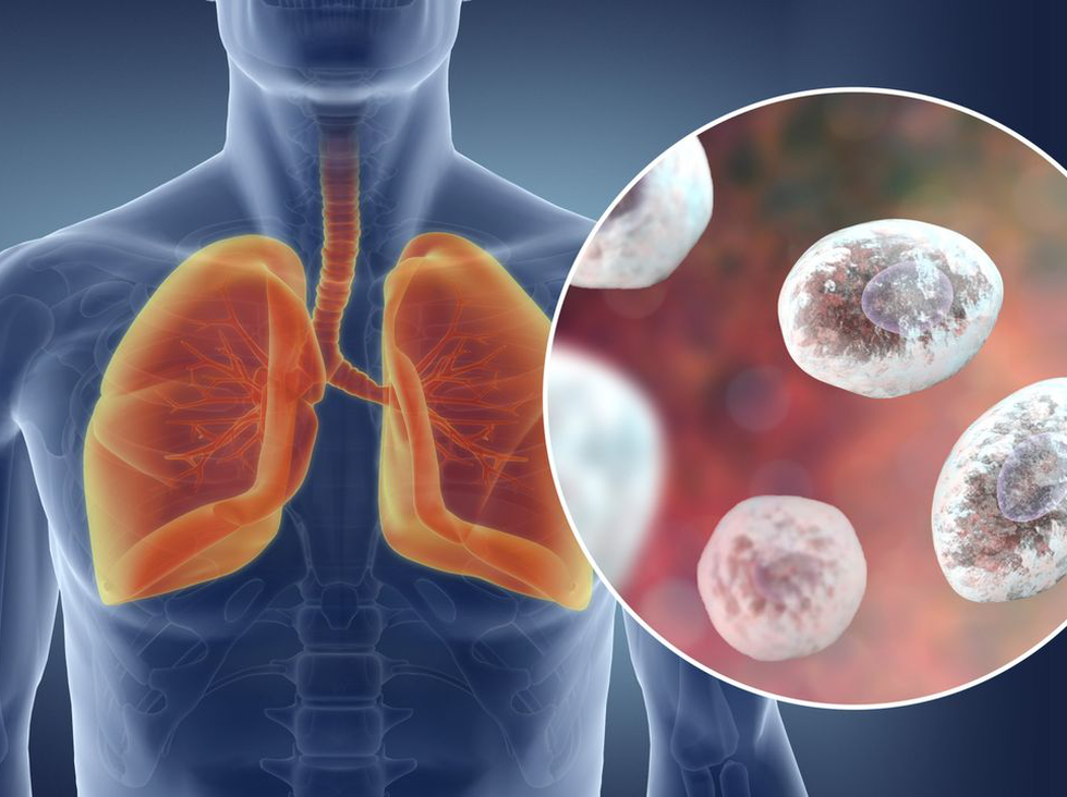 Viêm Phổi Pneumocystis Jirovecii Là Gì?